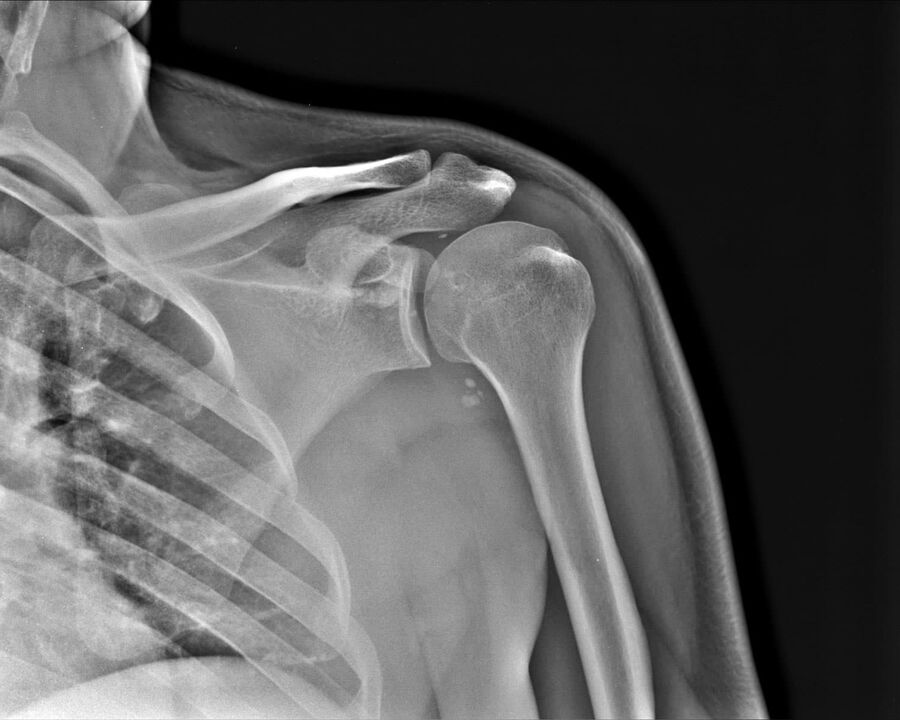 2. derecedeki omuz ekleminin artrozunun röntgeni