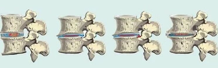 Torasik osteokondroz durumunda spinal lezyon