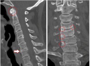 BT taraması, torasik osteokondroz nedeniyle hasarlı omurları ve heterojen yükseklikteki diskleri gösterir. 