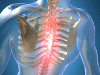 Göğüs osteokondrozunda tekrarlayan veya kalıcı ağrıyan ağrı
