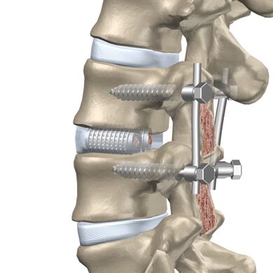 Torasik omurganın tahrip olmuş bir diskinin yapay bir implantla değiştirilmesi