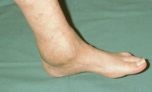 artrozlu ayak bileği şişmesi