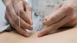 lomber osteokondroz için akupunktur