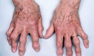 parmak artritini artrozdan nasıl ayırt edebilirim 