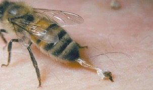 kalça artrozunun arılar tarafından tedavisi