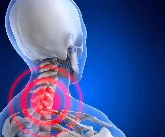 Servikal osteokondroz